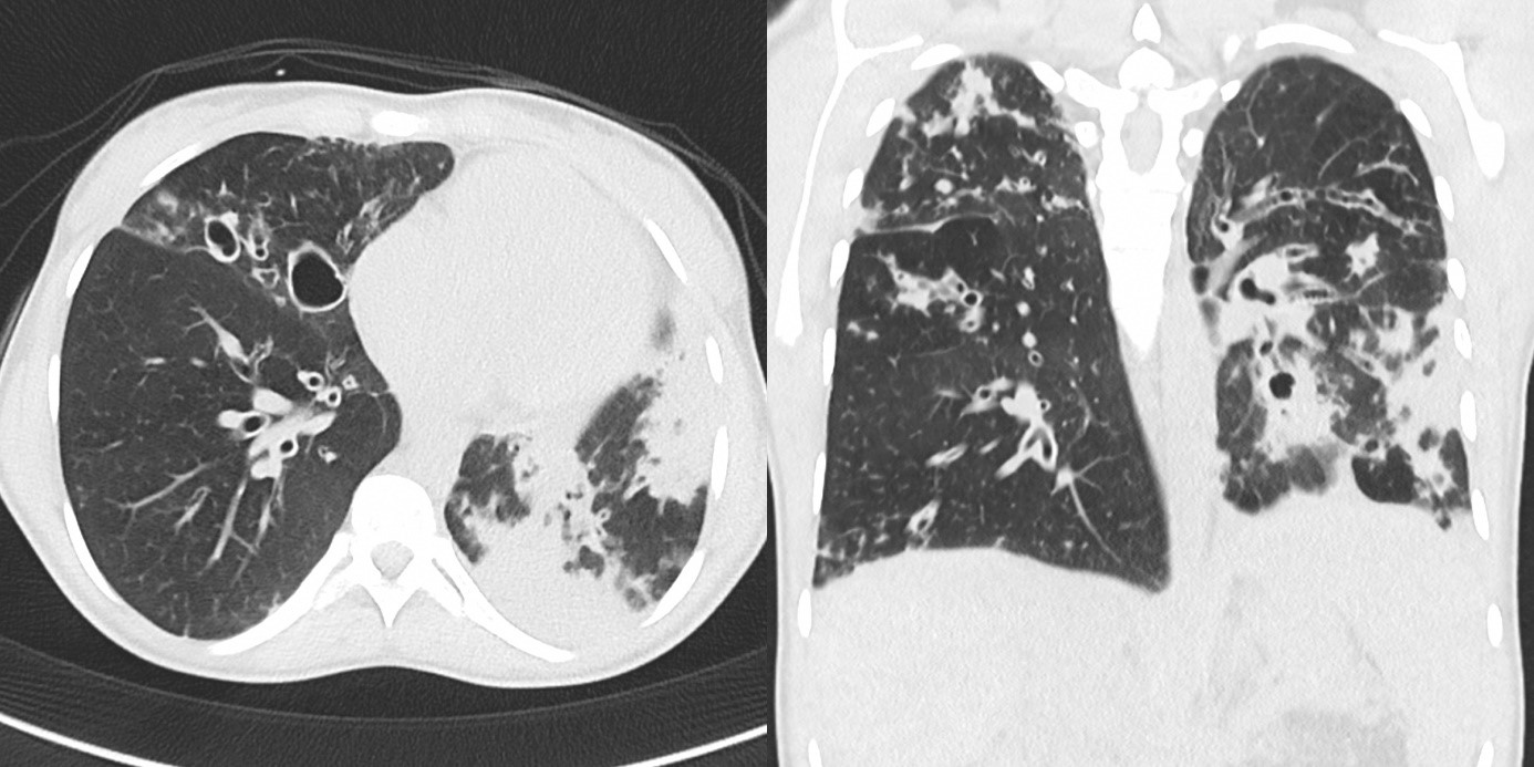 blog-mukoviszidose-e-v-bundesverband-cystische-fibrose-cf