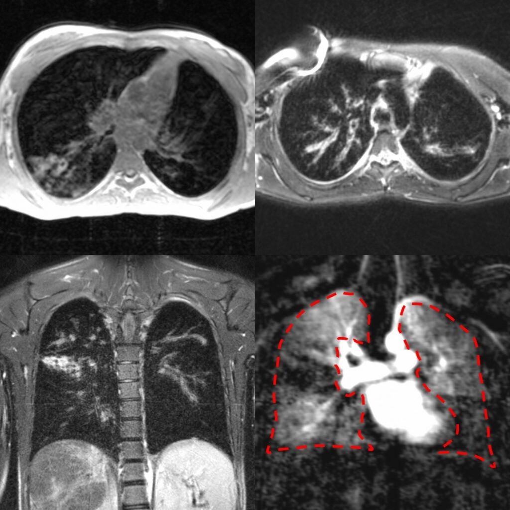 MRT-Aufnahme der Lunge einer Mukoviszidose-Patientin